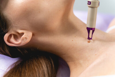 Удаление родинок